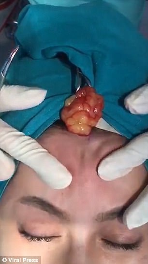 This gruesome footage shows Thai doctors squeezing out pus from a woman's forehead after her dermal filler became infected