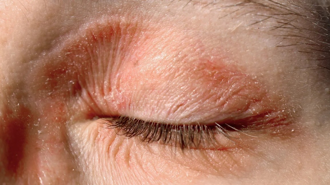 Reddish, discolored, dry scaly skin around the eye