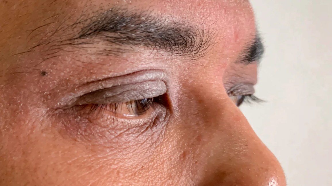 Reddish, discolored skin around the eye