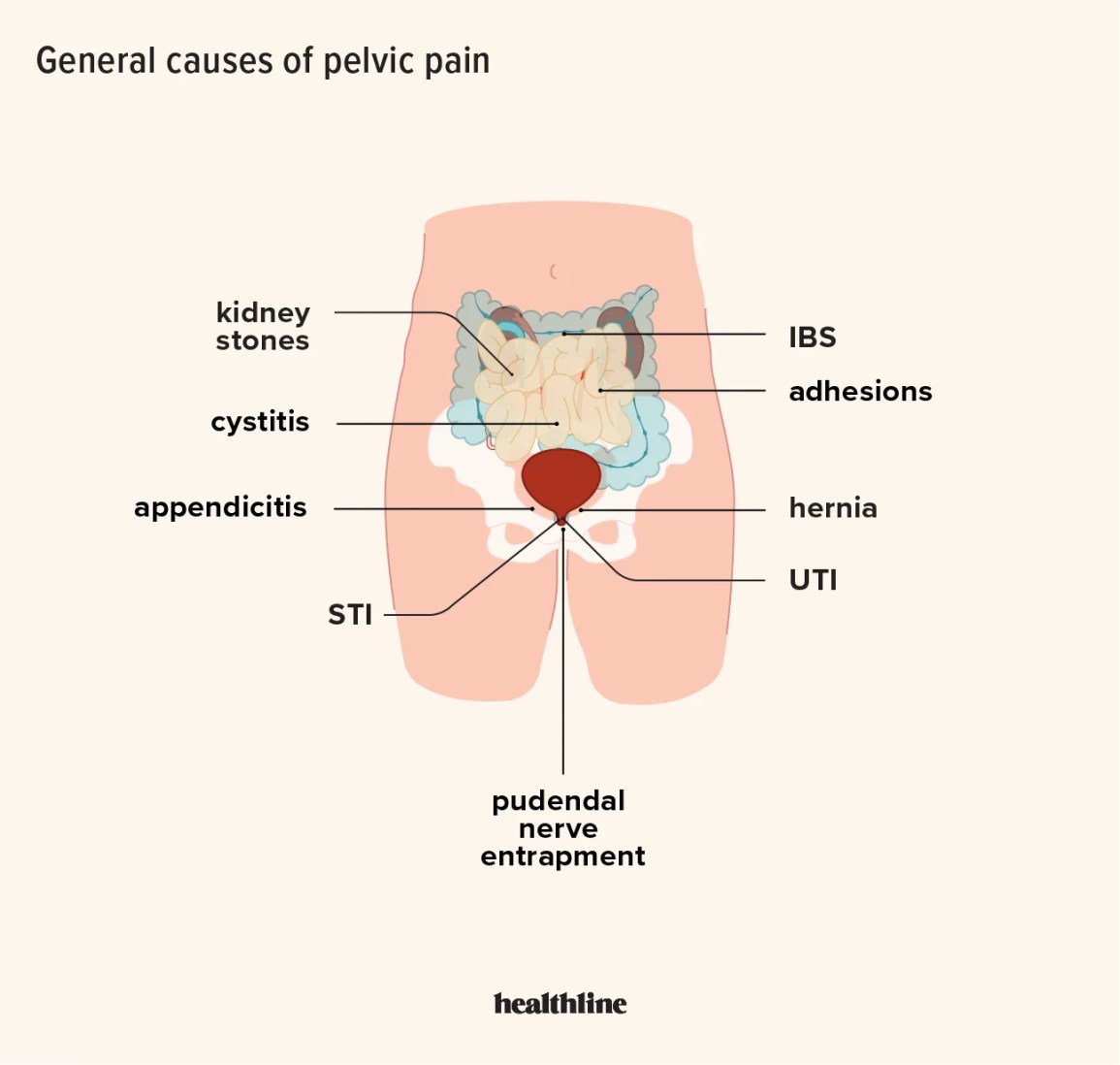 an illustration depicting possible causes of pelvic pain for anyone