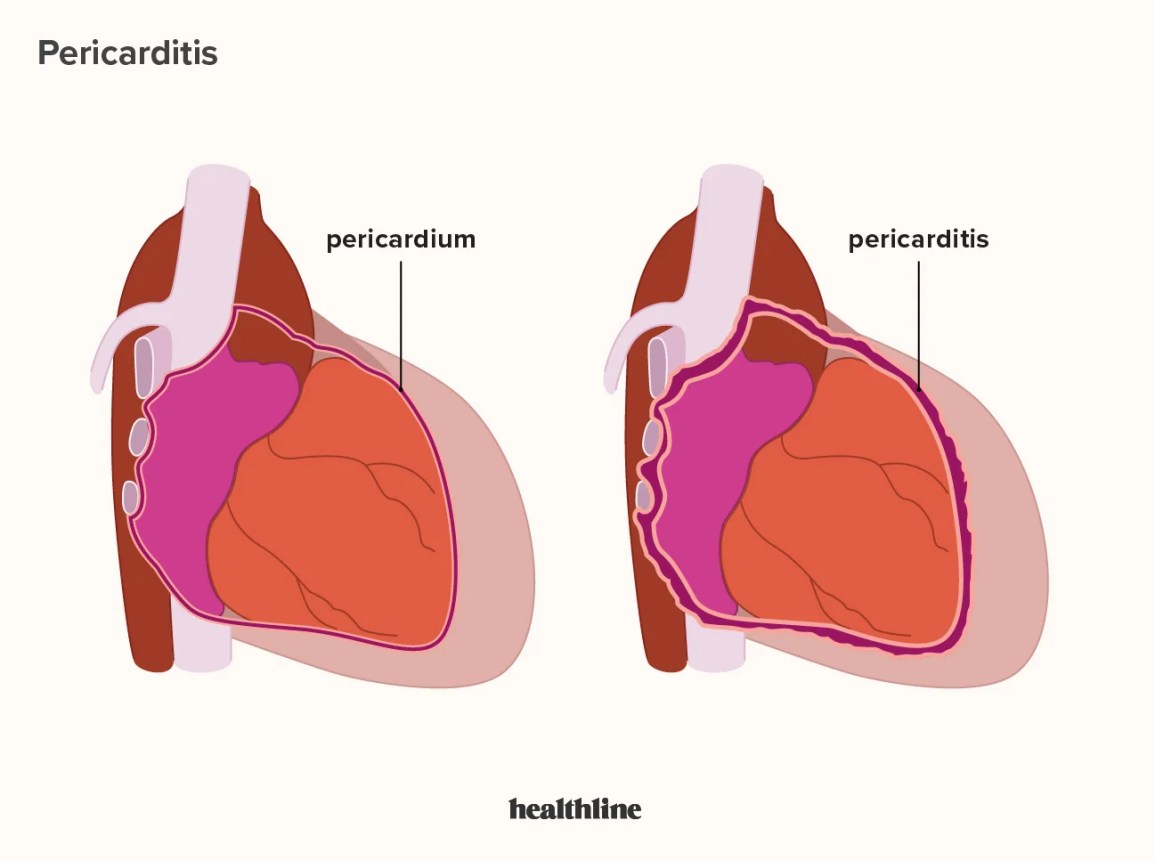 Pericarditis illustration