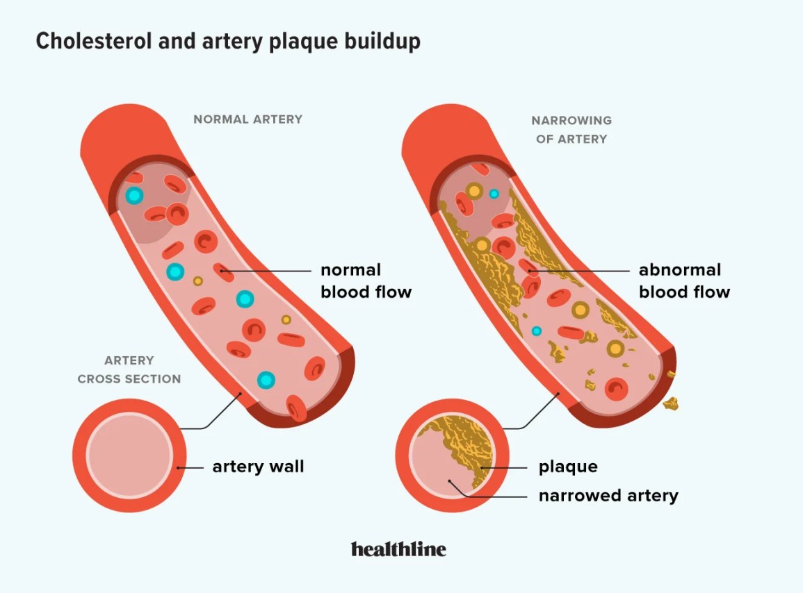 An illustration of how plaque can build up in the arteries. 