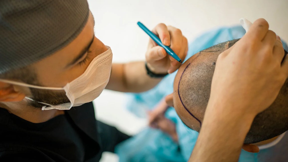 A surgeon outlining a person's hairline with a blue marker before beginning the hair transplant procedure.