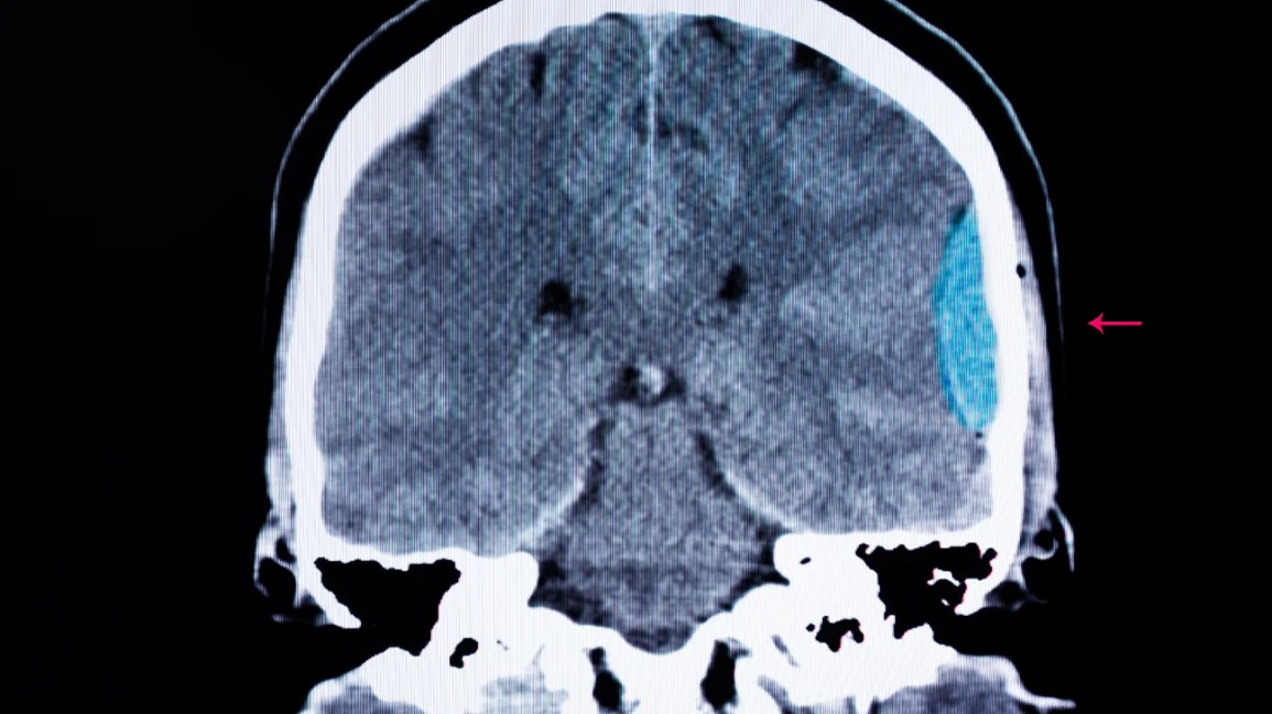 CT scan of an intracerebral brain hemorrhage