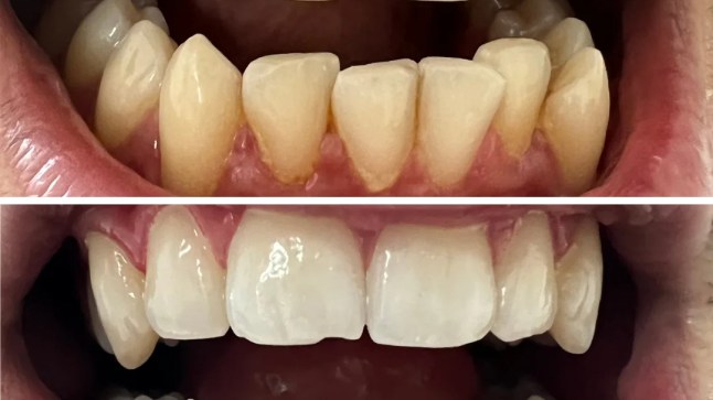 MySweetSmile before and after (Picture: MySweetSmile)