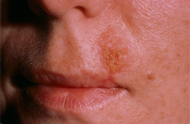 Upper Lip Of 30 Year Old Man. (Photo By BSIP/UIG Via Getty Images)