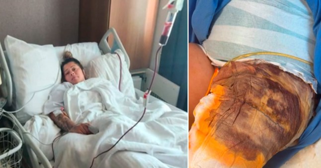 The woman woke up mid surgery during the cosmetic operation in Turkey which left her with serious infection and sepsis. (Picture: ITV News)