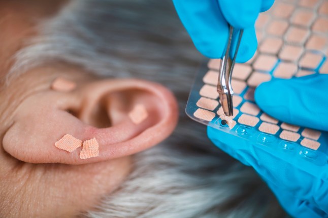 Auriculotherapy, or auricular treatment on human ear, close up. Therapist hand applying acupuncture ear seed sticker with tweezers.