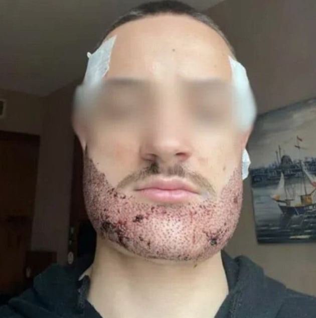 Mathieu Vigier Latour Student takes own life after botched beard transplant by estate agent in Turkey A young Frenchman took his own life after a botched beard transplant in Turkey performed by an estate agent posing as a surgeon.