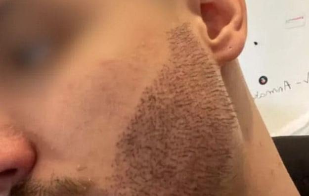 Mathieu Vigier Latour Student takes own life after botched beard transplant by estate agent in Turkey A young Frenchman took his own life after a botched beard transplant in Turkey performed by an estate agent posing as a surgeon.