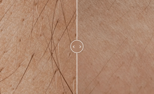 Image of hair removal after using the Keskine device at home