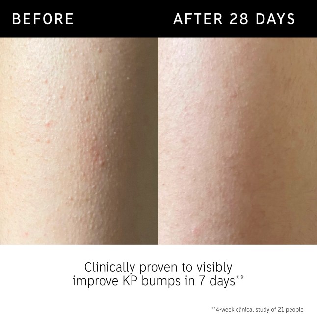 Before and after image of someone using The Inkey List Glycolic Acid Exfoliating Body Stick