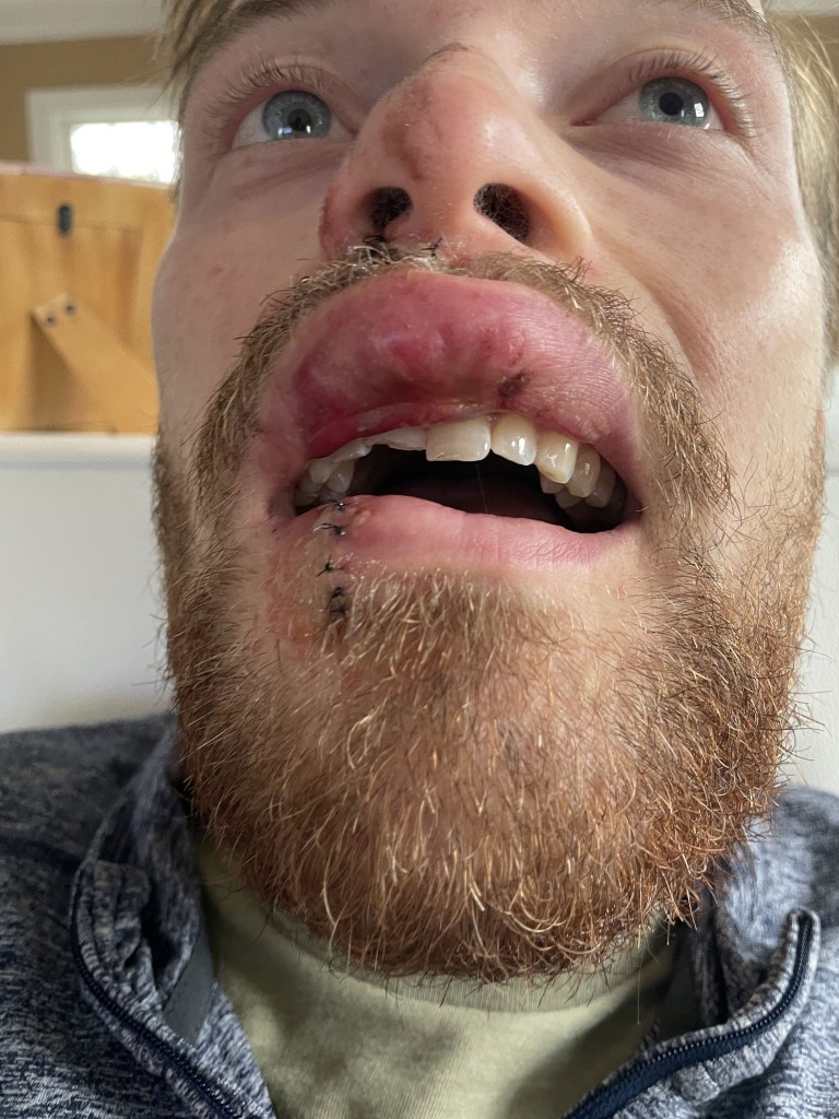 An unlucky groom busted his lip and lost a tooth before his wedding day.