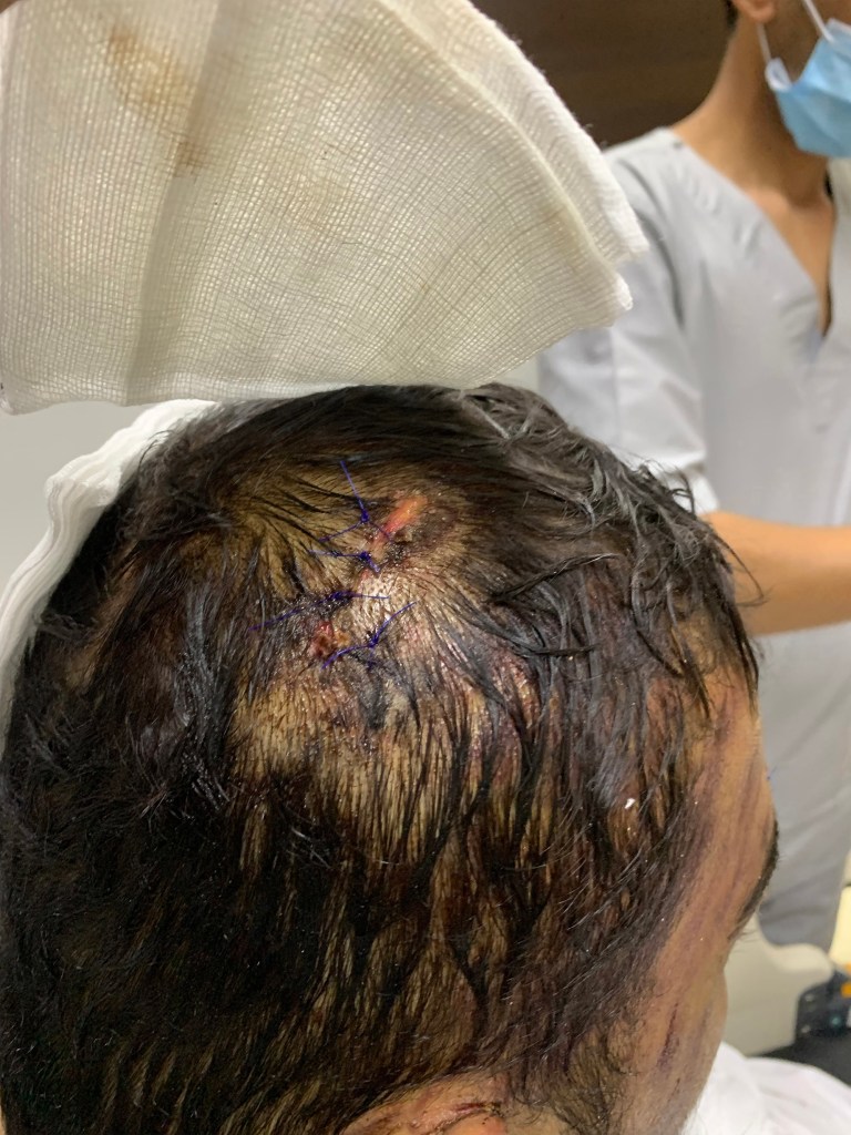 Bukhari suffered three separate head wounds during the fall, which required a total of eight stitches.