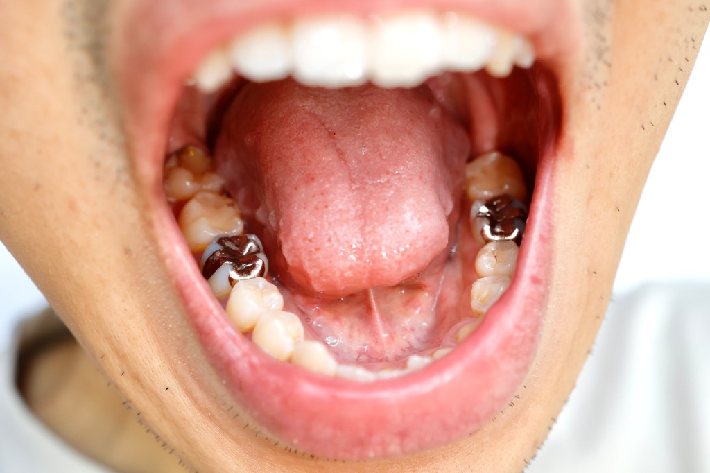 Metal fillings in mouth