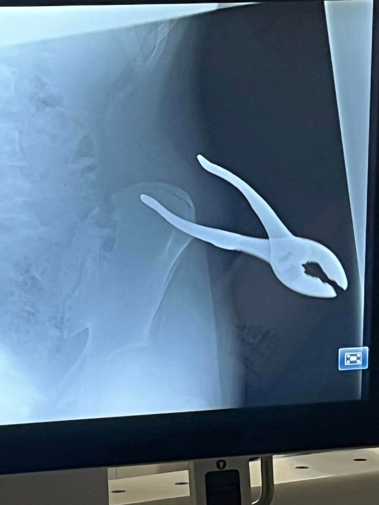 X-ray image of pliers in hip