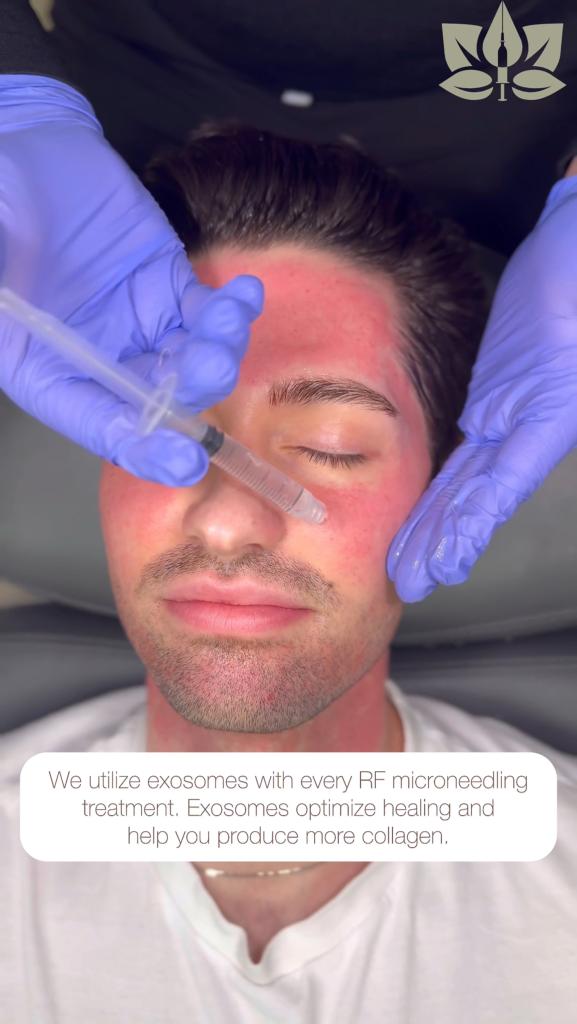 A man receiving exosomes treatment at Lushful Aesthetics, a new trend in dermatology