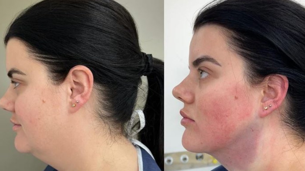 Side profile view of Angela Hutchinson post-liposuction showing the result of her chin procedure