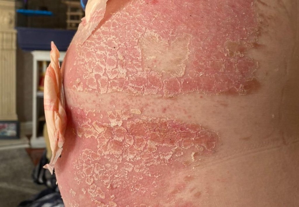 Man experiencing chemical burns on the side of his buttocks due to an allergic reaction to hair removal cream