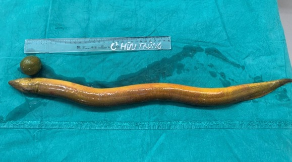 eel and lime removed in surgery