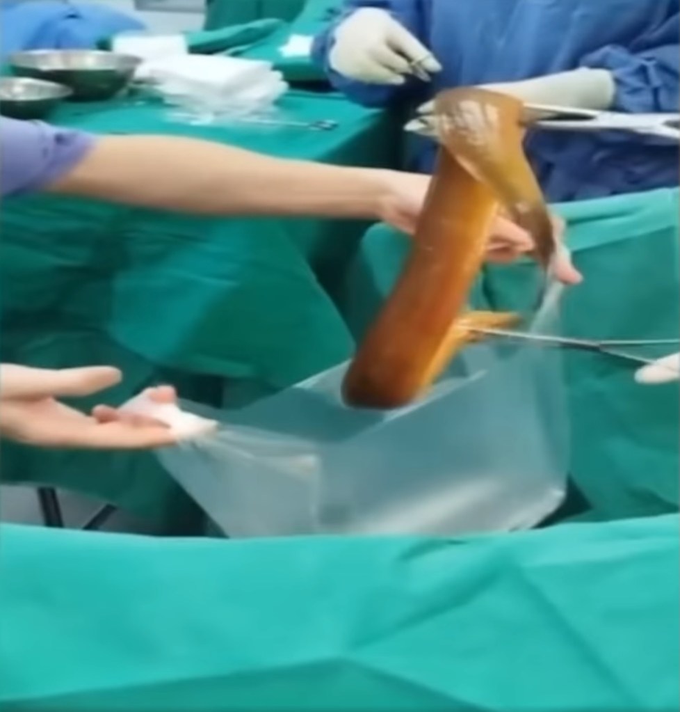 eel surgery removal