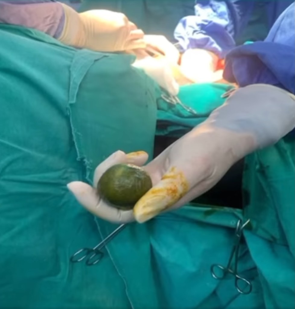 lime removed in surgery