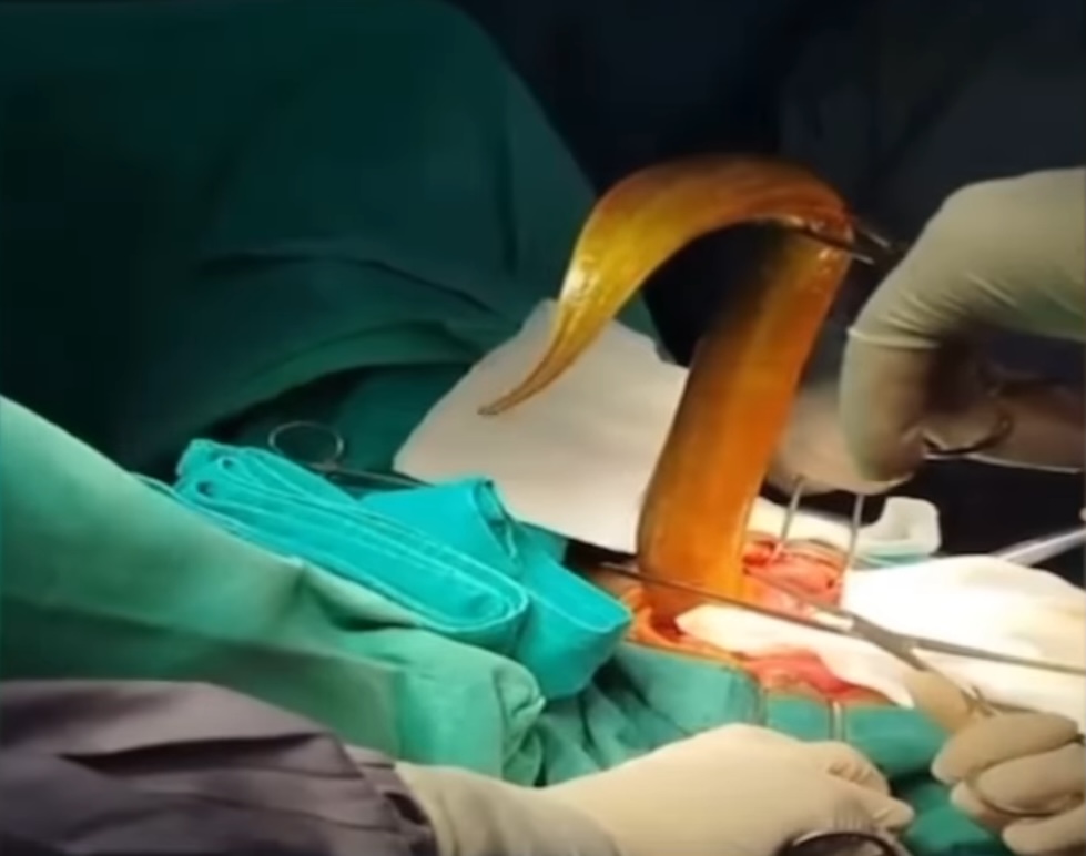 eel surgery