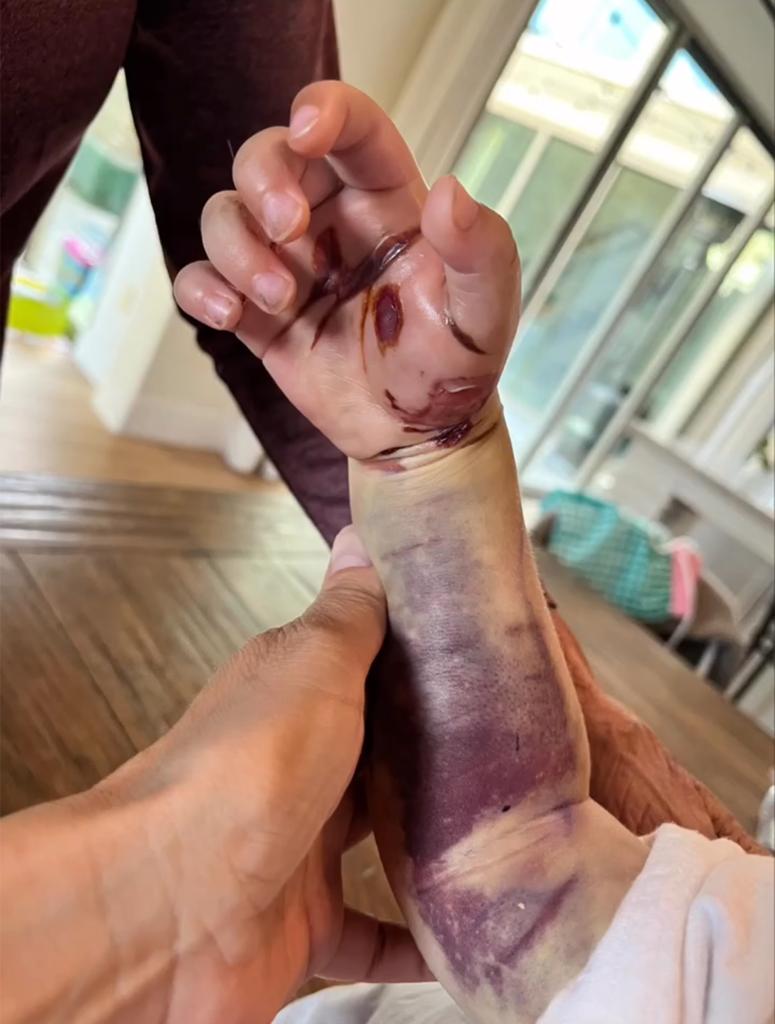 The snake bite was on his right hand between his thumb and index finger.