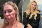 Brandi Glanville has spent over $70K trying to figure out the cause of her facial disfigurement