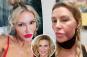 Brandi Glanville 'lost 5 teeth' while battling facial disfigurement, heath issues