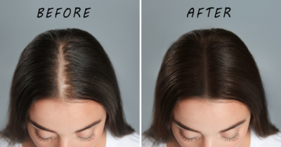 Explained: What is the correct way of massaging Coconut Oil to regrow hair in bald patches?