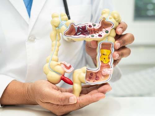 Gesunder Darm, leichteres Abnehmen: 8 Lebensmittel besser meiden