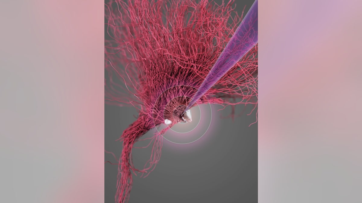 A visual representation of the deep brain stimulation of the of the lateral hypothalamus