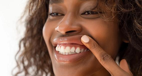 Person lifting up lift to show teeth and gums