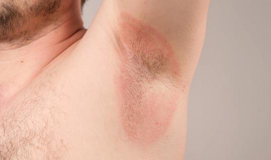 Red and irritated skin on the armpit of a person with their arm raised