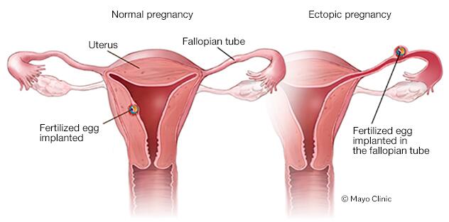 Normal vs. ectopic pregnancy