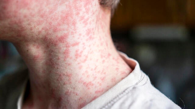 Measles viral disease, human skin covered with measles rash, vaccination concept 