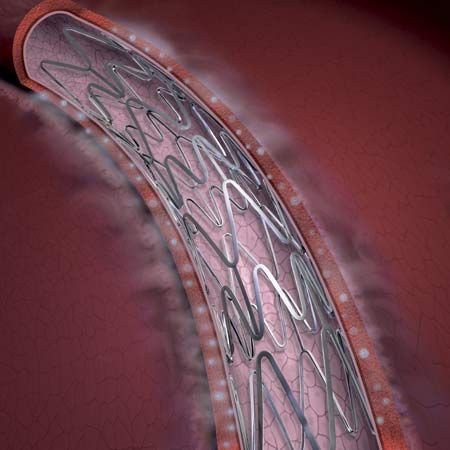 drug-eluting stent