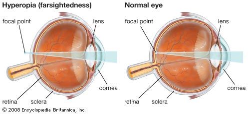 hyperopia