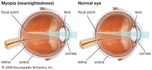 myopia