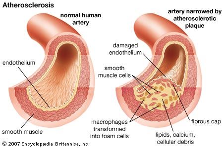 atherosclerosis