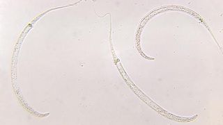 Under a magnification of 125X, this photomicrograph revealed the presence of three Guinea worms, Dracunculiasis medinensis.