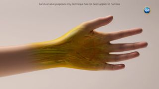 Medical illustration showing a close-up of a person's arm and hand with the palm facing towards the viewer, against a beige-colored background. Some of the hand is shown in yellow and blood vessels are visible. 