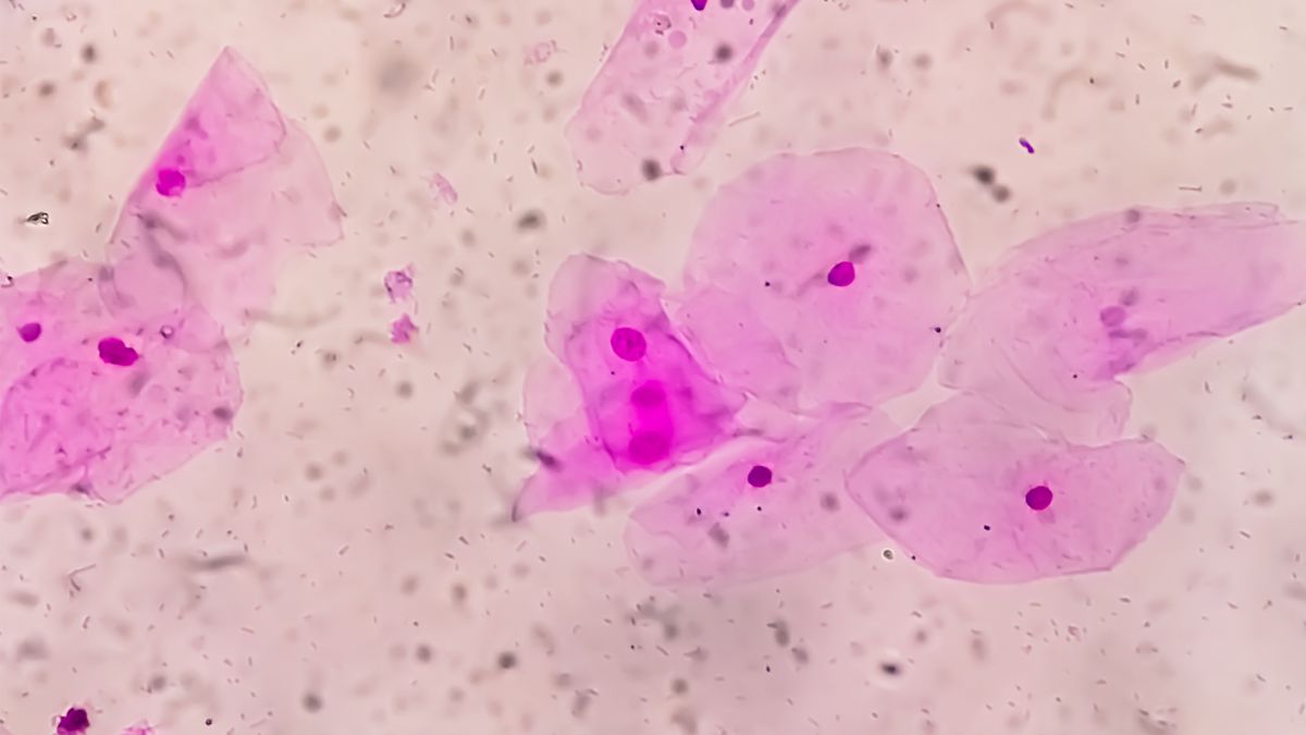 Photomicrograph of gram stain showing Bacterial Vaginosis.