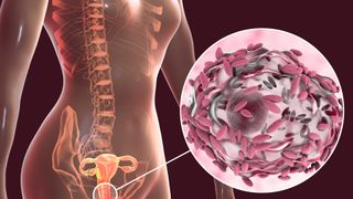 Bacterial vaginosis, computer illustration. Female reproductive system and Gardnerella vaginalis bacteria (rods) attached to vaginal epithelial cells, known as clue cells.