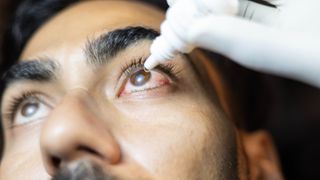 Close up of a person using eye drops in their eye which is very pink and likely conjunctivitis