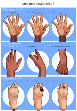 Cancer Researchers need illustrations to help people identify rare skin cancer | Illustration Design by smiledim24