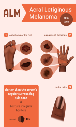 Cancer Researchers need illustrations to help people identify rare skin cancer | Illustration Design by Aistikart