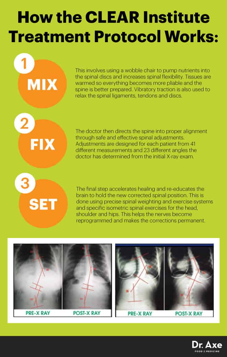 Scoliosis exercises CLEAR Institute protocol - Dr. Axe