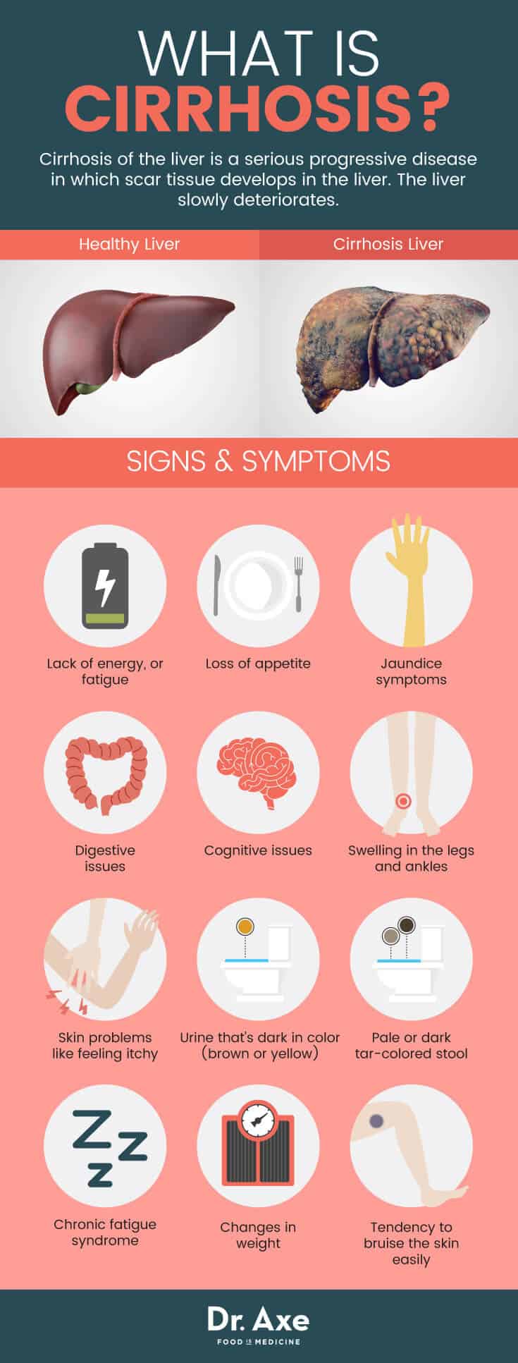 What is cirrhosis